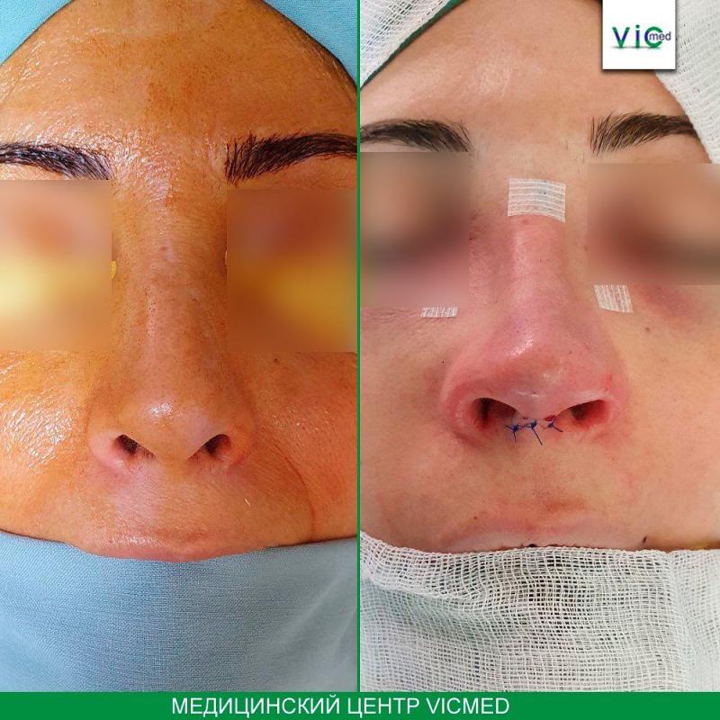 երկրորդային վիրահատություն вторичная ринопластика