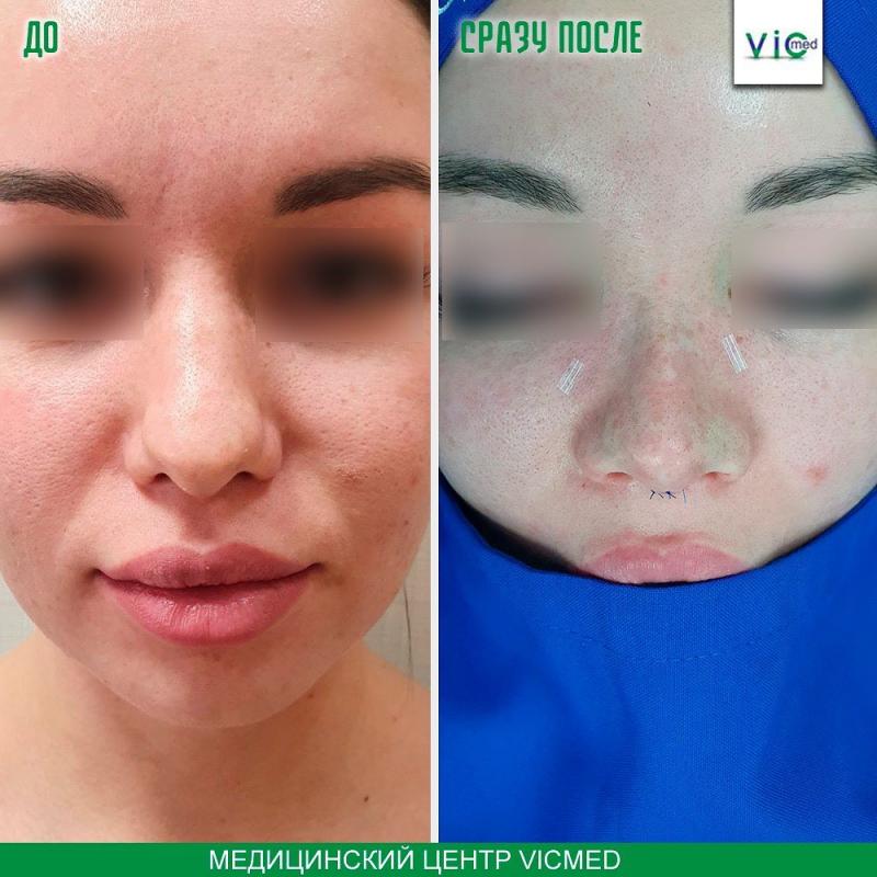 հետո առաջ անմիջական վիրահատությունից հետո до после сразу после операции