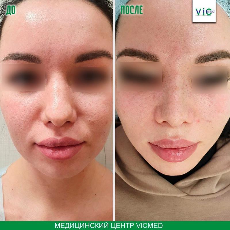 հետո առաջ օր անց գիպսը հանելուց հետո до после дней спустя сразу после снятия гипса