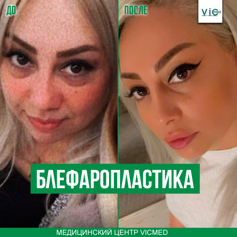 բլեֆարոպլաստիկա տարի անց блефаропластика спустя год