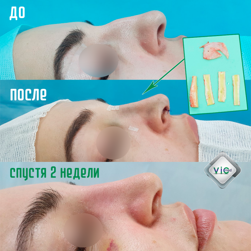 ռինոպլաստիկա շաբաթ անց ринопластика недели спустя