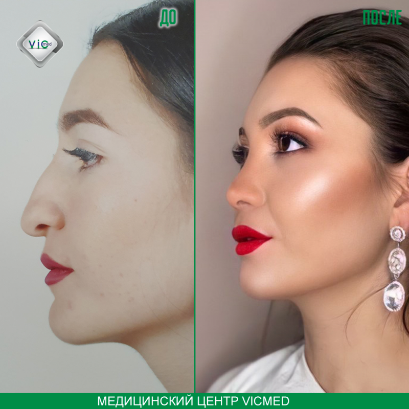 ռինոպլաստիկա ринопластика спустя пару месяцев