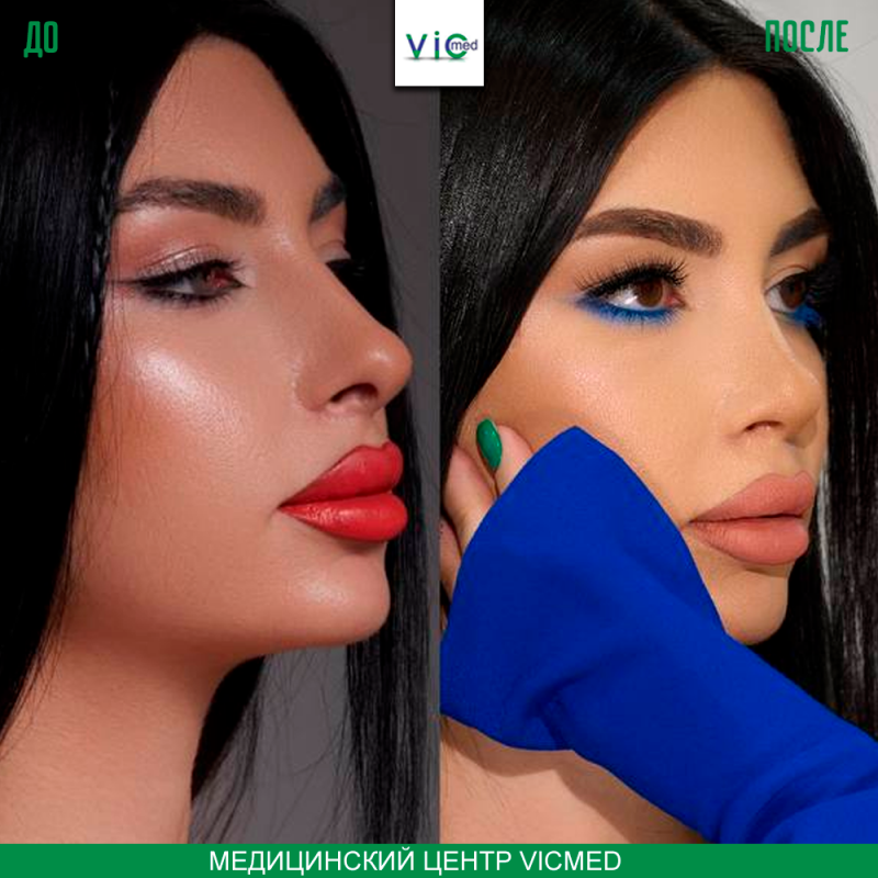 ռինոպլաստիկա ринопластика спустя дней