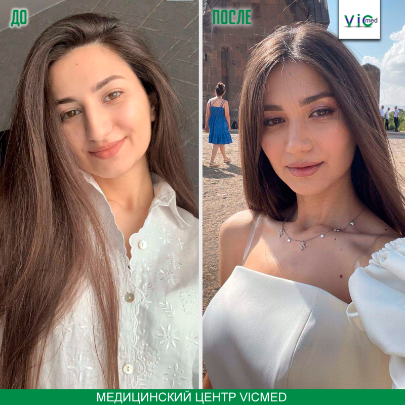 ռինոպլաստիկա ринопластика спустя месяца