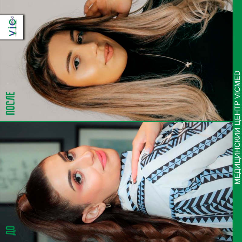 ռինոպլաստիկա