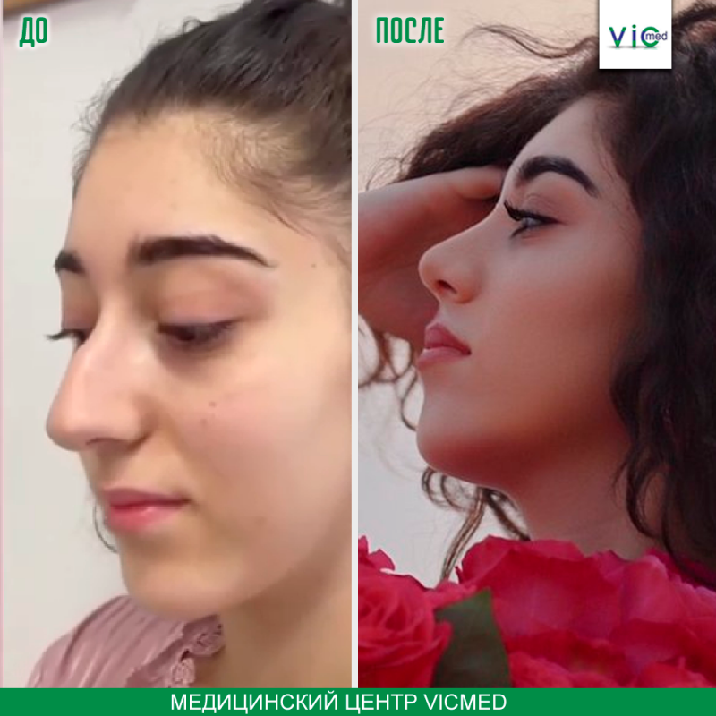 ամիս անց ռինոպլաստիկա спустя месяцев после ринопластики