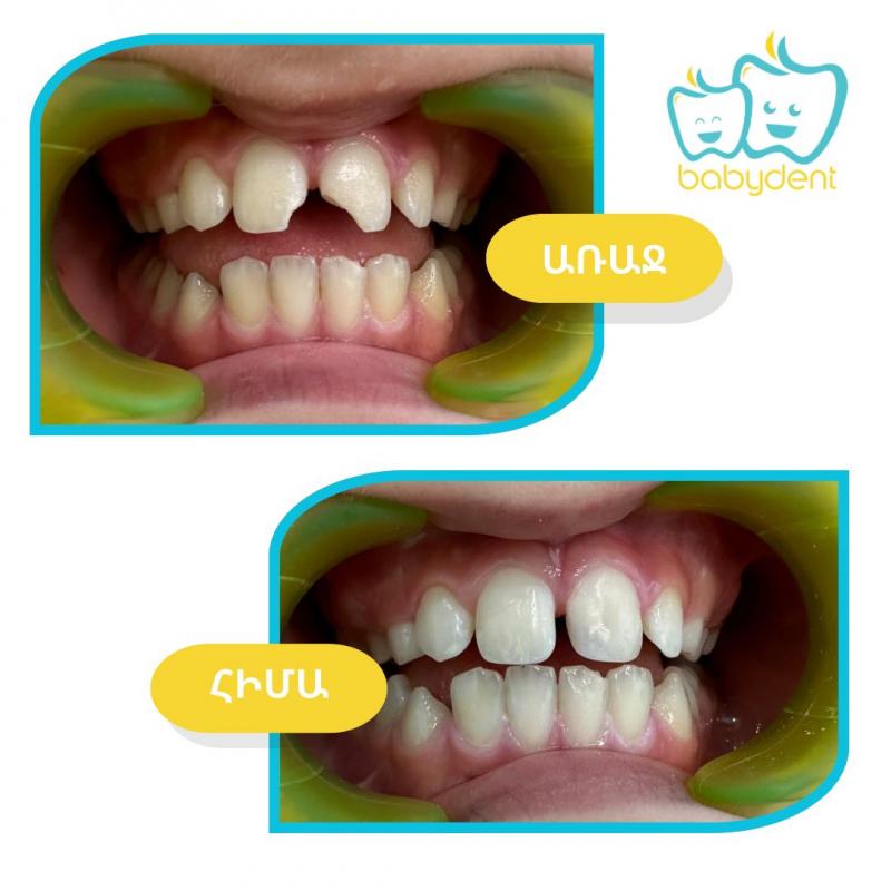 վնասված ատամի էսթետիկ վերականգնում