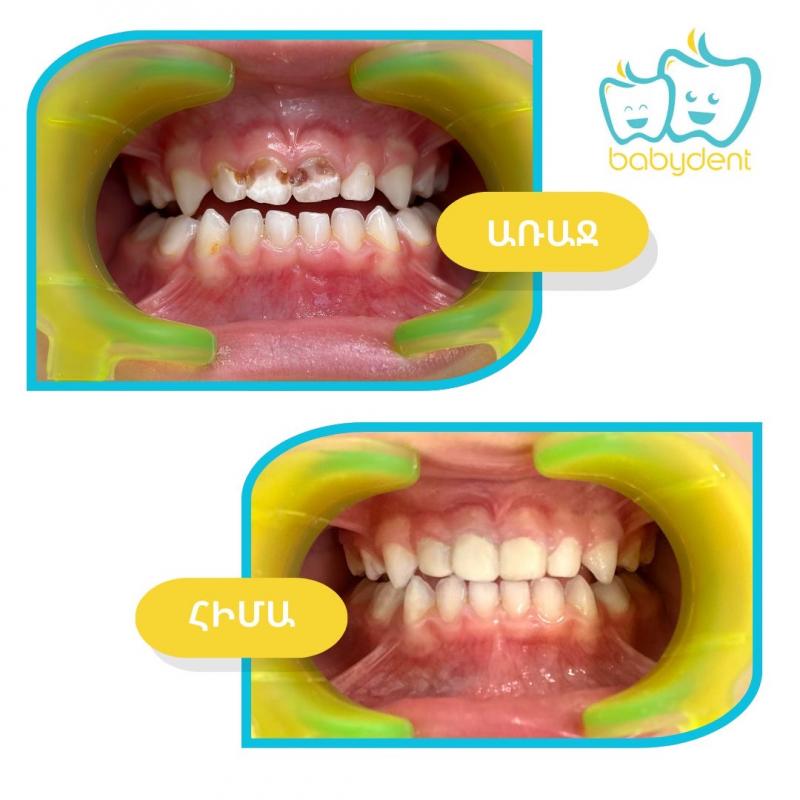 երեխայի ծնողը դիմել է դիմային ատամների ցավով խախտված էր կծողական ֆունկցիան կատարվել է դիմային ատամների նյարդի հեռացում և էսթետիկ վերականգնում լուսային պլոմբավորման միջոցով